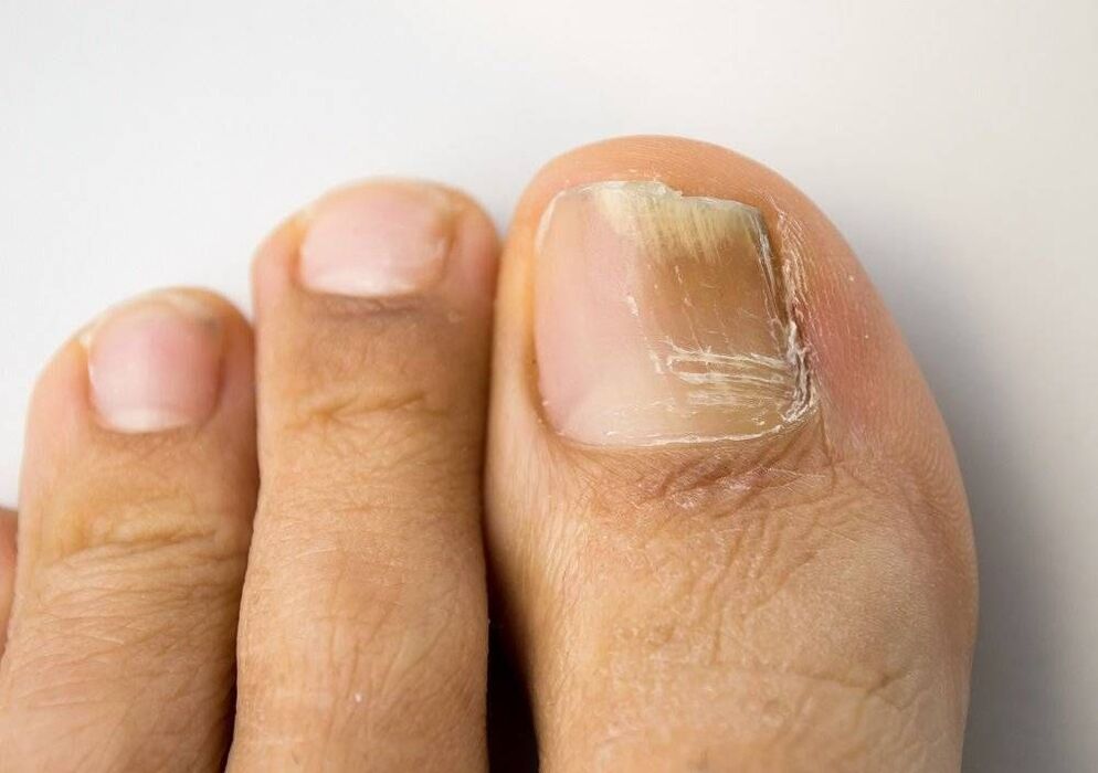 types of fungal infection of the big toe