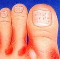 The fungus of the feet