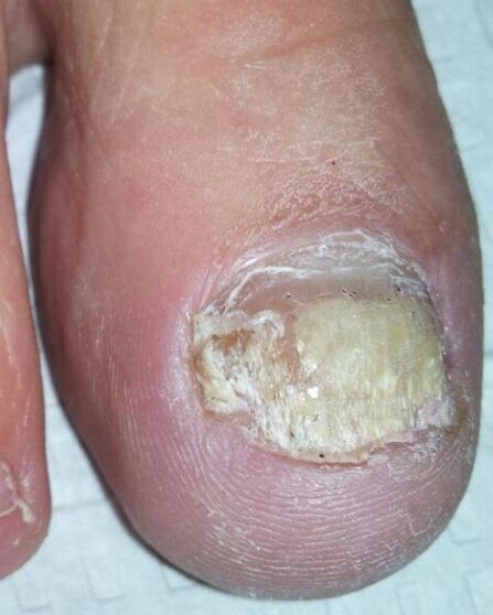 The fungus of the feet