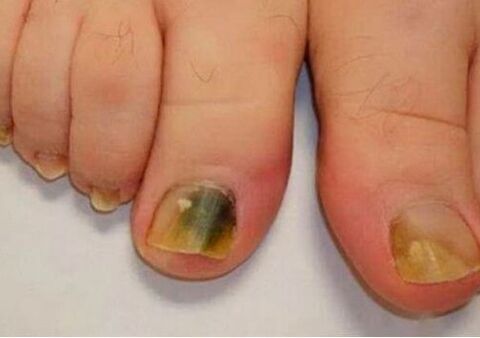 The infection affects the plaques for the nails