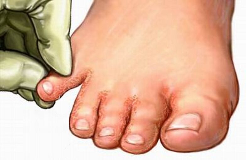The fungus of the feet