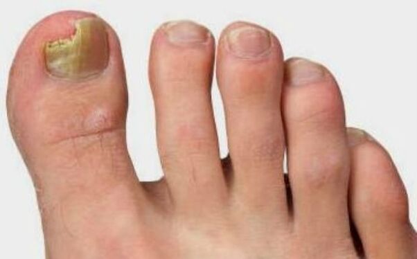 Fungus of the thumb