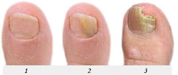 The process of developing the fungus of the thumb