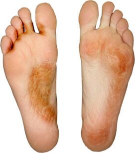 Heal the fungus on your finger and do not take it again