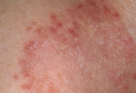 How to quickly heal the fungus, the doctor will say