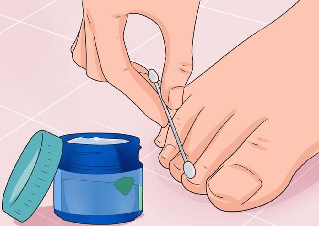 Treat nail fungus