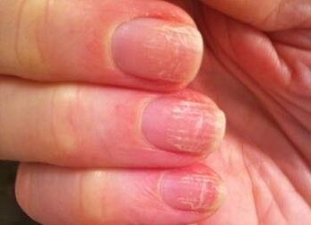 The initial stage of the nail fungus