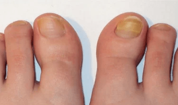 The initial stage of the nail sponge
