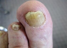 The causes of nail fungus appearance