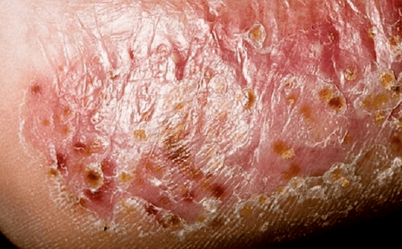 Leg fungus