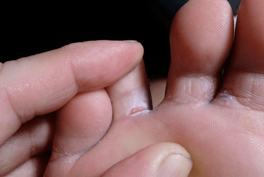 The appearance of the bubbles of the legs
