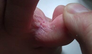 Stages of the development of fungi between the toes