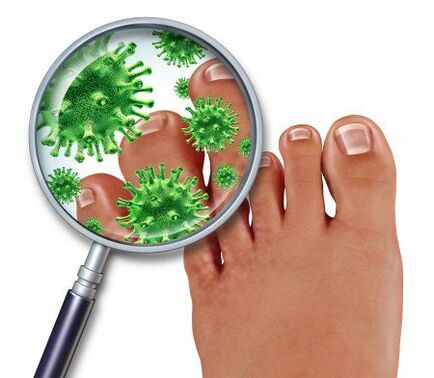 fungal infection of the feet