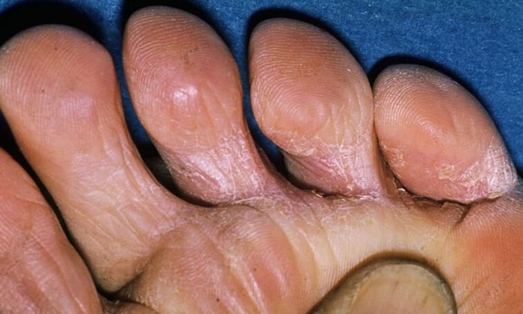 Different types of fungus on the feet