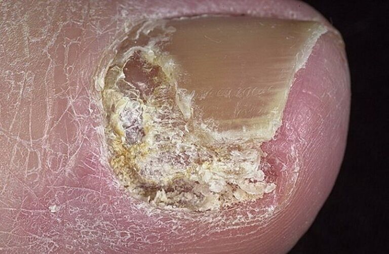 Species of onychomycosis
