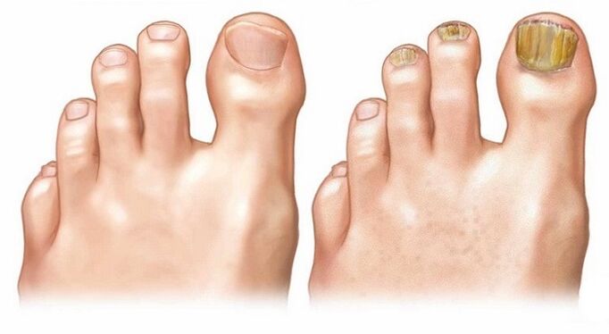 healthy nails and toenail fungus