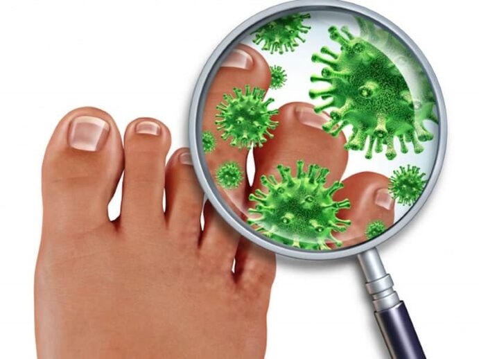 Nail fungus affects people with weakened immunity