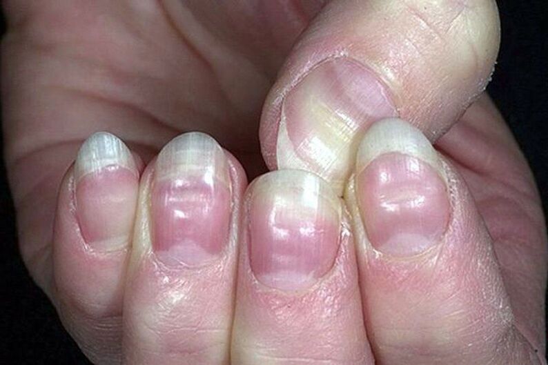 leukonychia of the nails