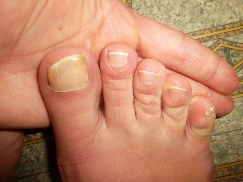 onychomadesis of the feet