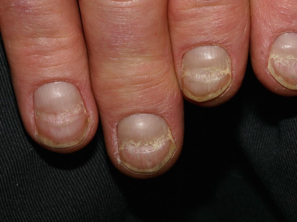 onychosis of the nail plate